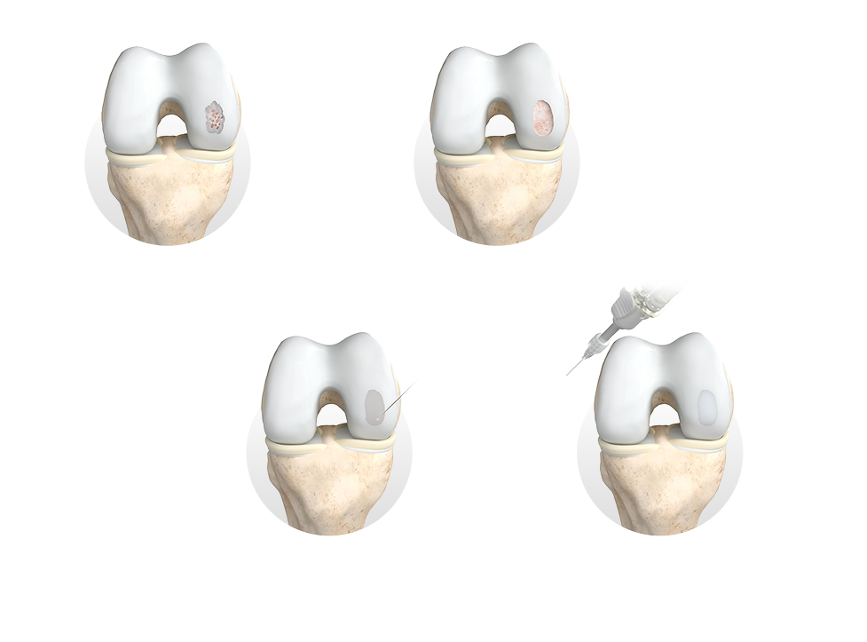 how chondrofiller works steps